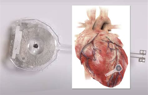 can i read a pacemaker externally using nfc|can my pacemaker be disabled.